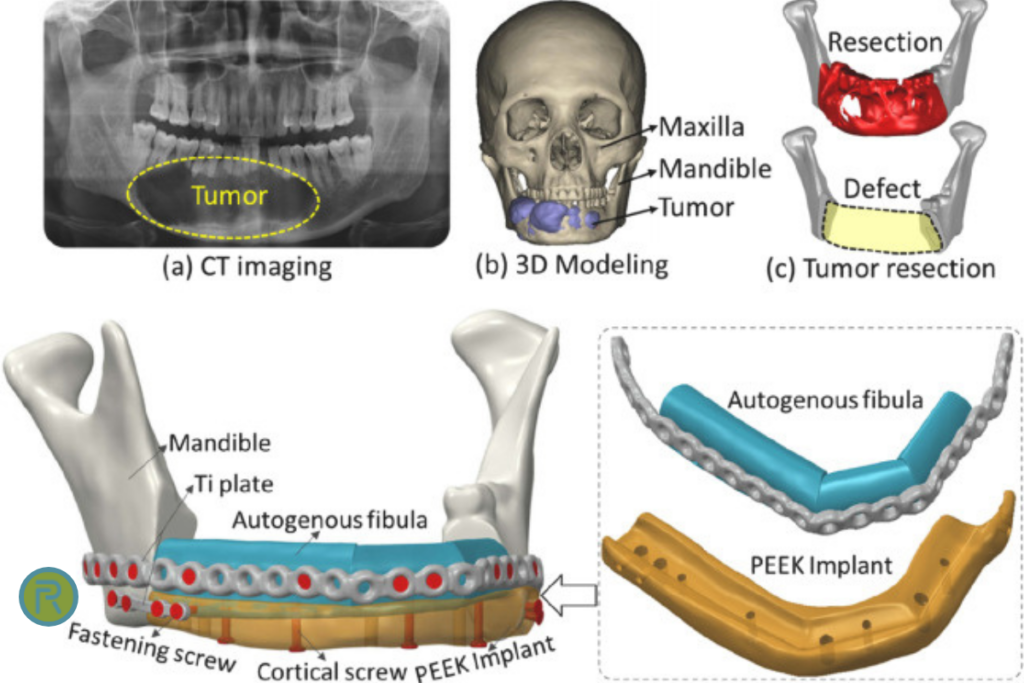 3D printed PEEK implants